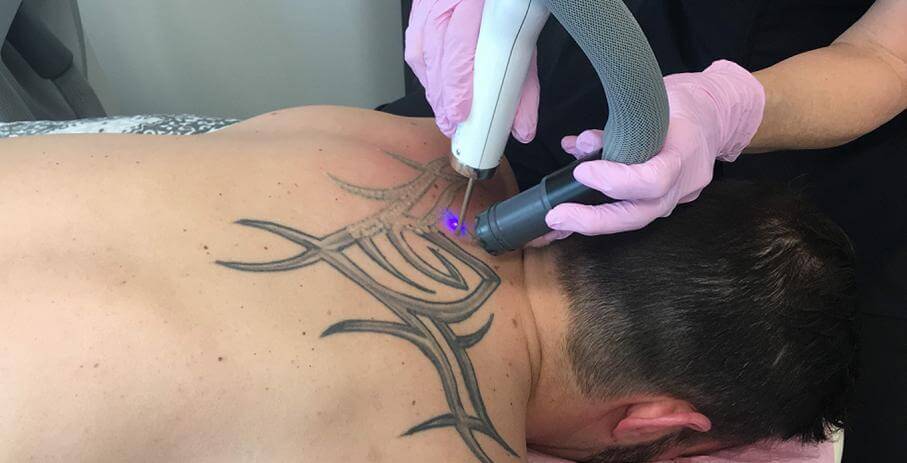 Laser tattoo removal